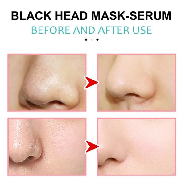 EELHOE Tečna maska za mitisere i akne